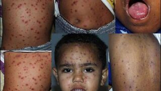 Chickenpox
