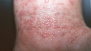 Skin Disease
