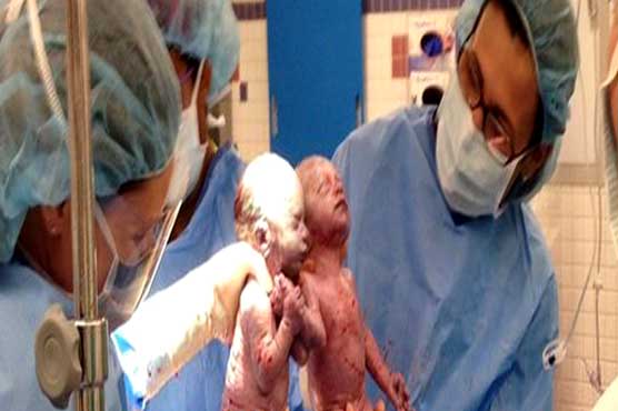 امریکہ: ایک دوسرے کا ہاتھ تھامے جڑواں بہنوں کی پیدائش