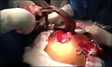 جنوبی امریکا : ایک شخص کی آنت سے 4  فٹ لمبی زندہ مچھلی نکال لی گئی