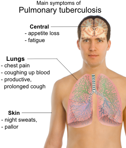 Pulmonary tuberculosis symptoms