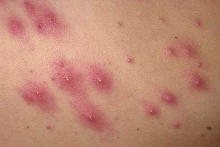 بدلتا موسم، جلدی امراض میں اضافہ