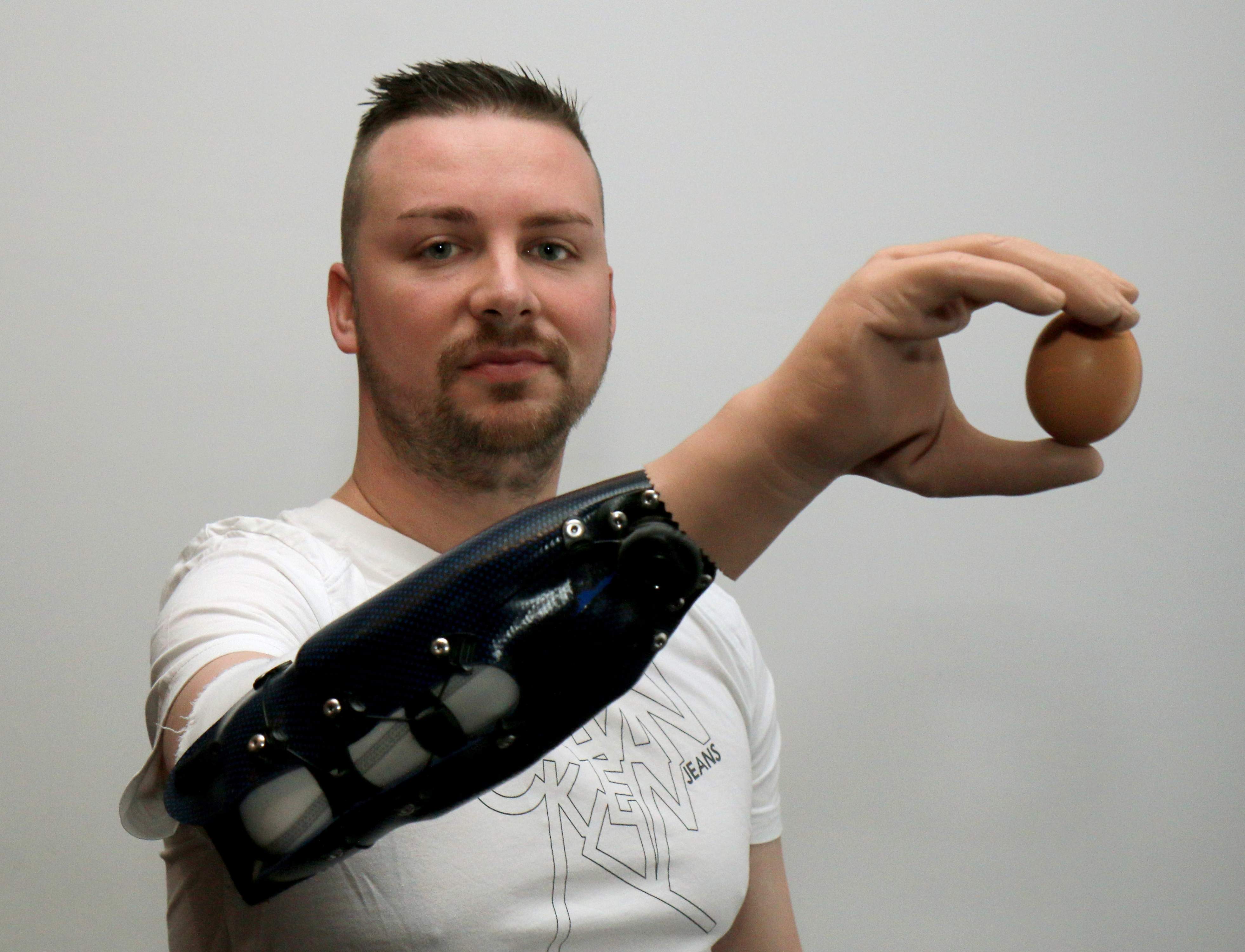 معذور افرد کے لیے ’بائیونک ہینڈز‘