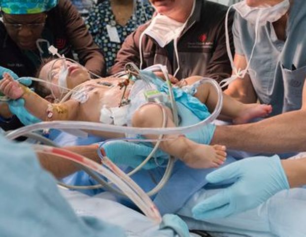 سوئٹزرلینڈ میں پہلی مرتبہ دھڑ جڑی بچیوں کا کامیاب آپریشن