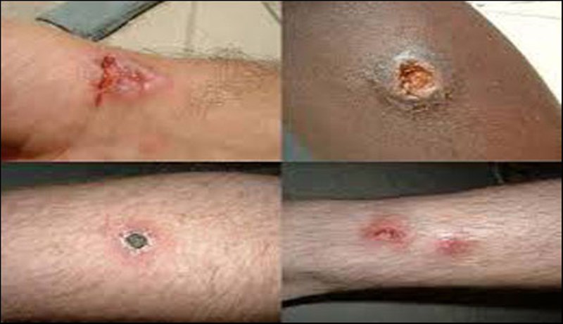 کرک:سینڈ فلائی نامی مکھی کا درجن سے زائد بچوں پر حملہ