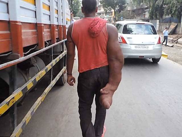 بھارت میں نوجوان پراسرار بیماری میں مبتلا جس میں بازو کا وزن بڑھ کر20 کلو تک پہنچ گیا