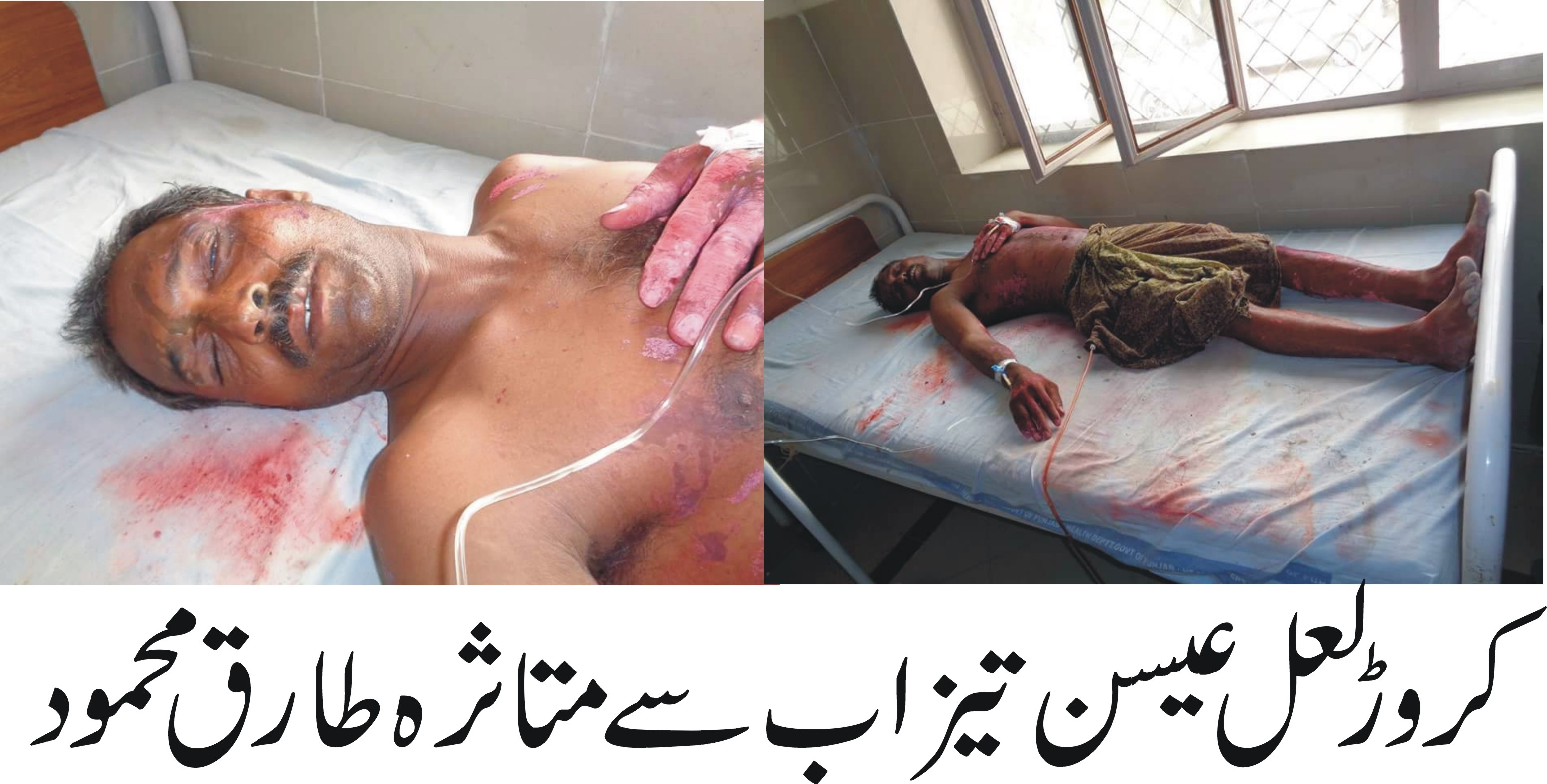 طارق محمود پر سگے بھائیوں اور بہنوئی نے وٹہ سٹہ کی شادی کے تنازعہ پر تیزاب پھینک دیا
