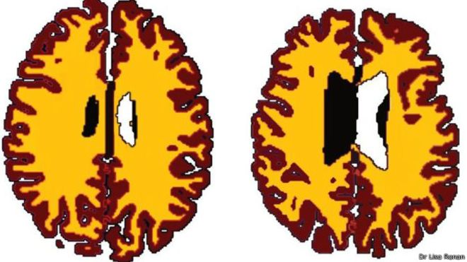 موٹاپے سے ’دماغ بوڑھا‘ ہو جاتا ہے