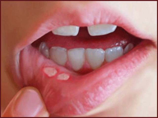 منہ کے چھالوں سے نجات کے 6 آسان گھریلو نسخے