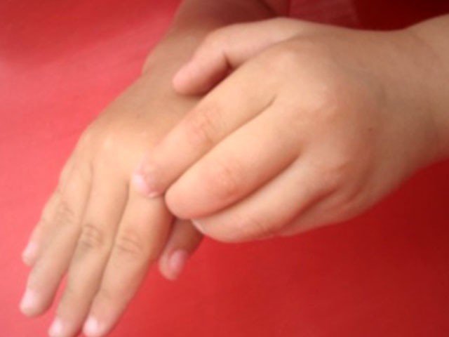 Allergy