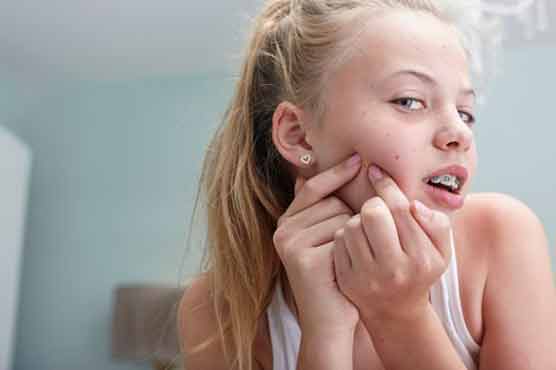 چہرے پر مہاسوں کی وجہ سے بڑھاپے کے اثرات جلد ظاہر نہیں ہوتے: تحقیق