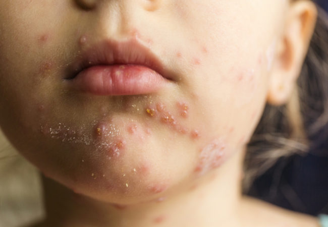 انسداد خسرہ مہم ، صحت مند نئی نسل کے لیے پرعزم پاکستان