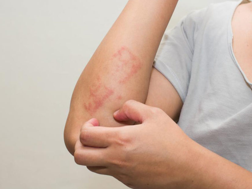 الرجی کی تین اقسام