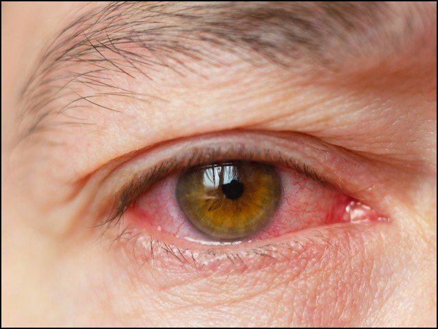 فضائی آلودگی، مستقل نابینا پن کی وجہ بن سکتی ہے