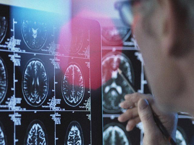 مرگی میں مبتلا افراد کے دماغ جلد ‘بوڑھے’ ہو جاتے ہیں، ماہرین